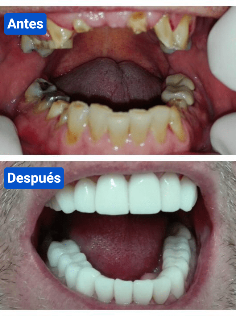 Before and after costa rica dental clinic