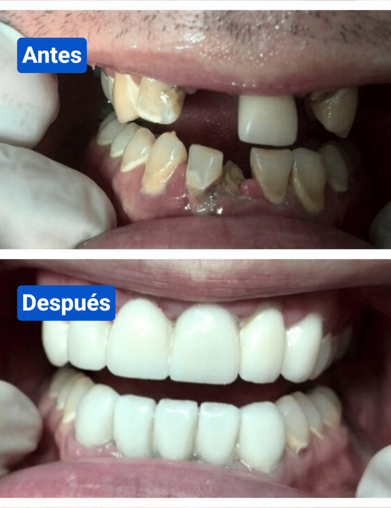 Before and after costa rica dental clinic