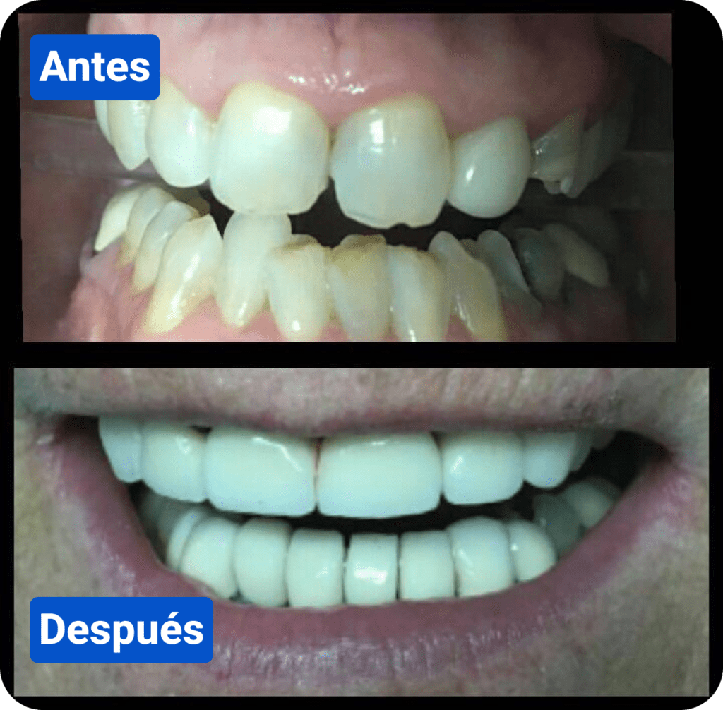 Before and after costa rica dental clinic