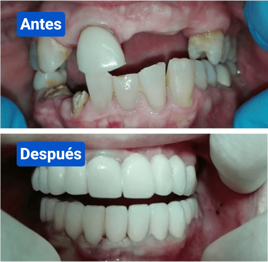 Before and after costa rica dental clinic