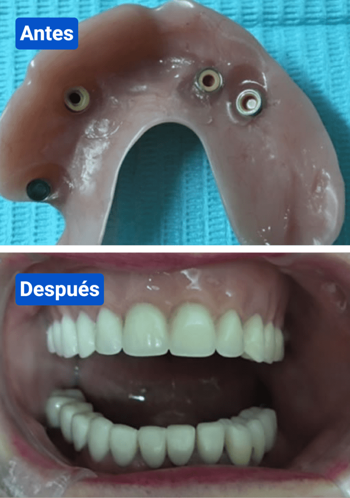 Before and after costa rica dental clinic