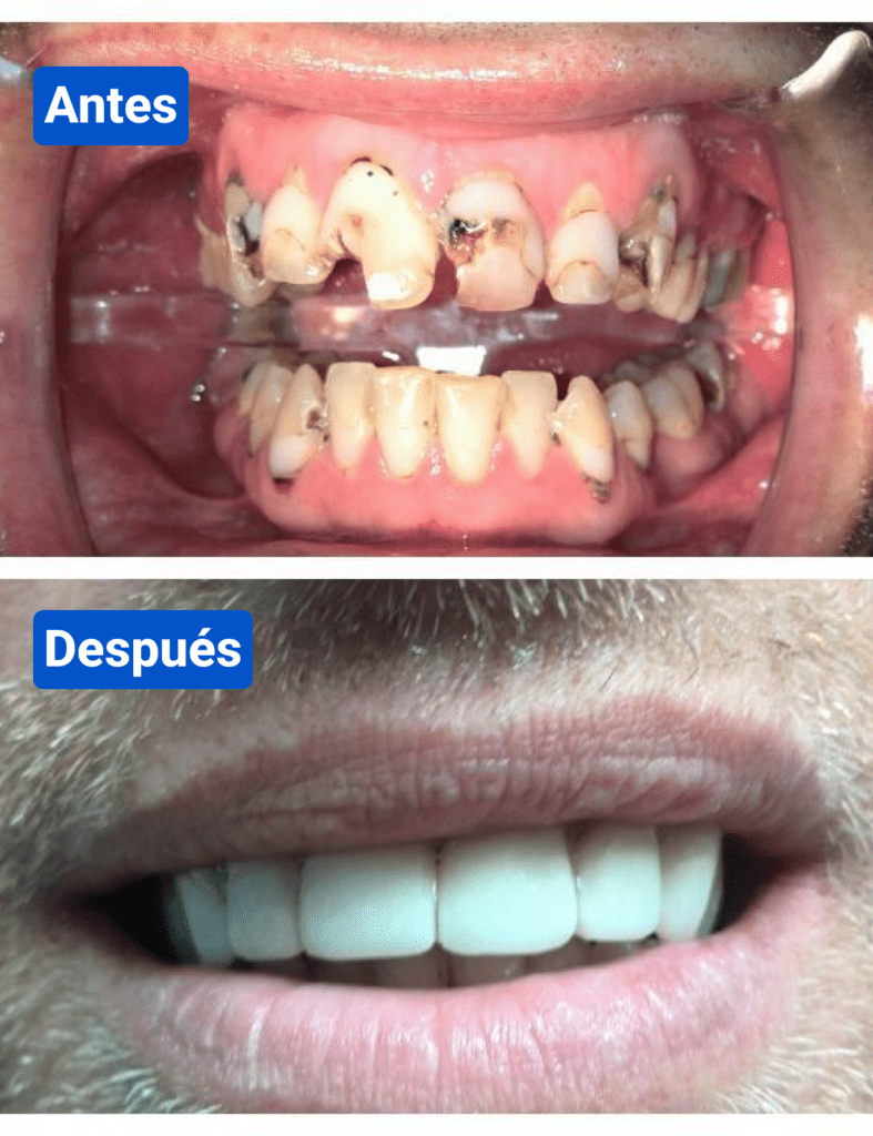 Before and after costa rica dental clinic