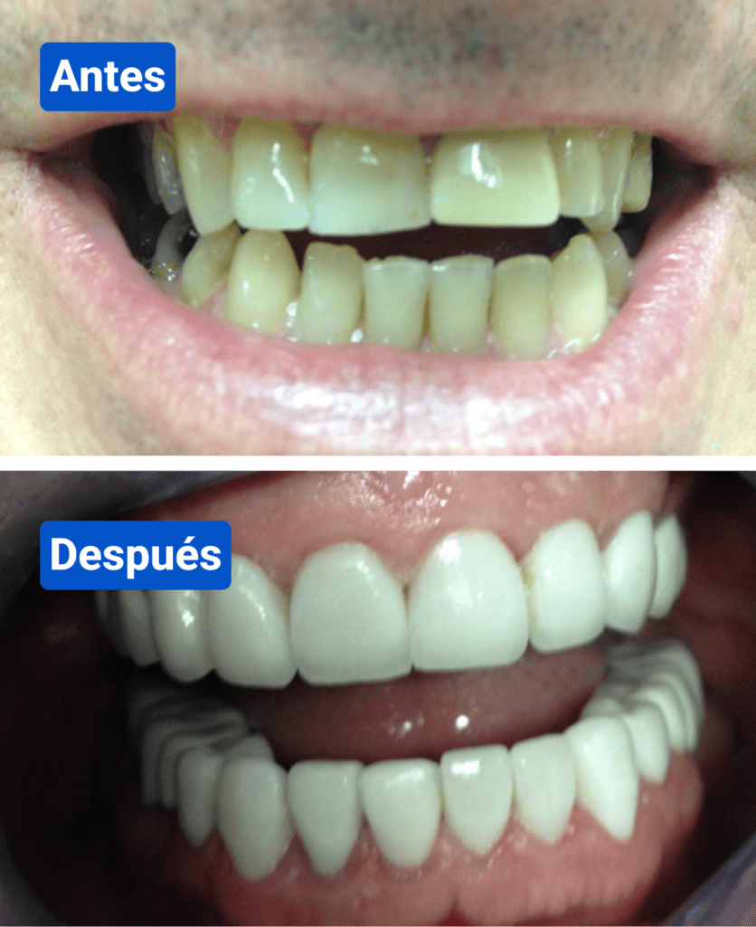 Before and after costa rica dental clinic