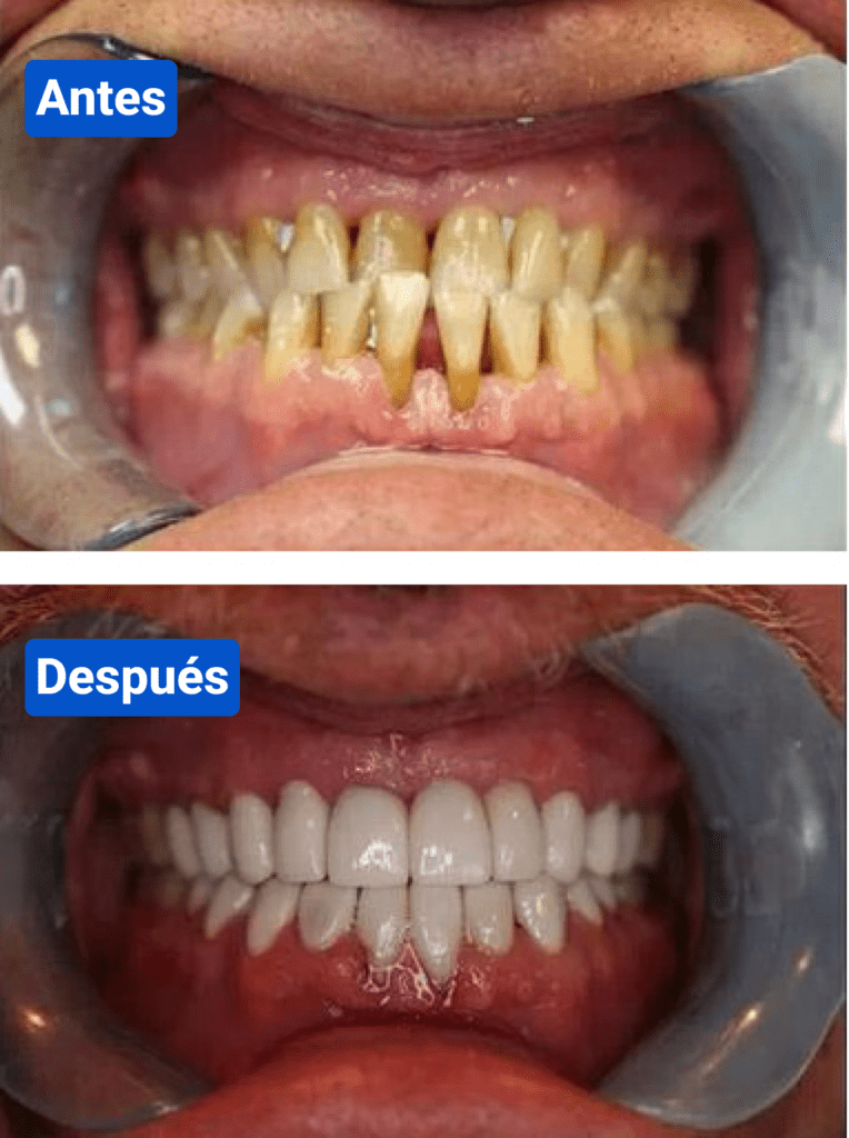 Before and after costa rica dental clinic