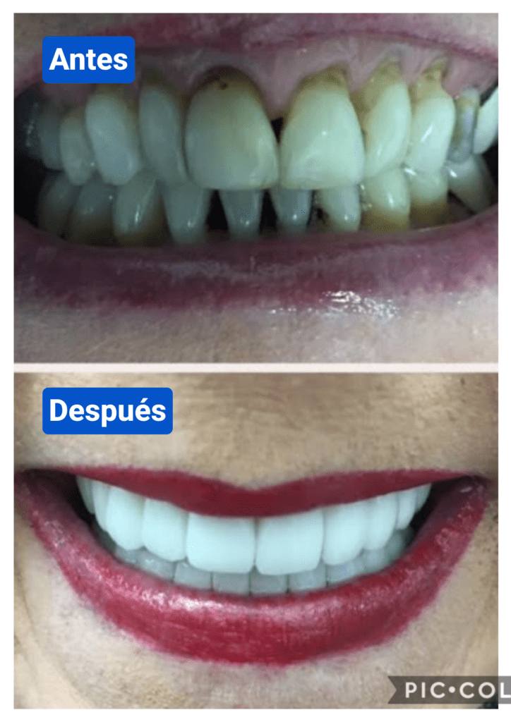 Before and after costa rica dental clinic