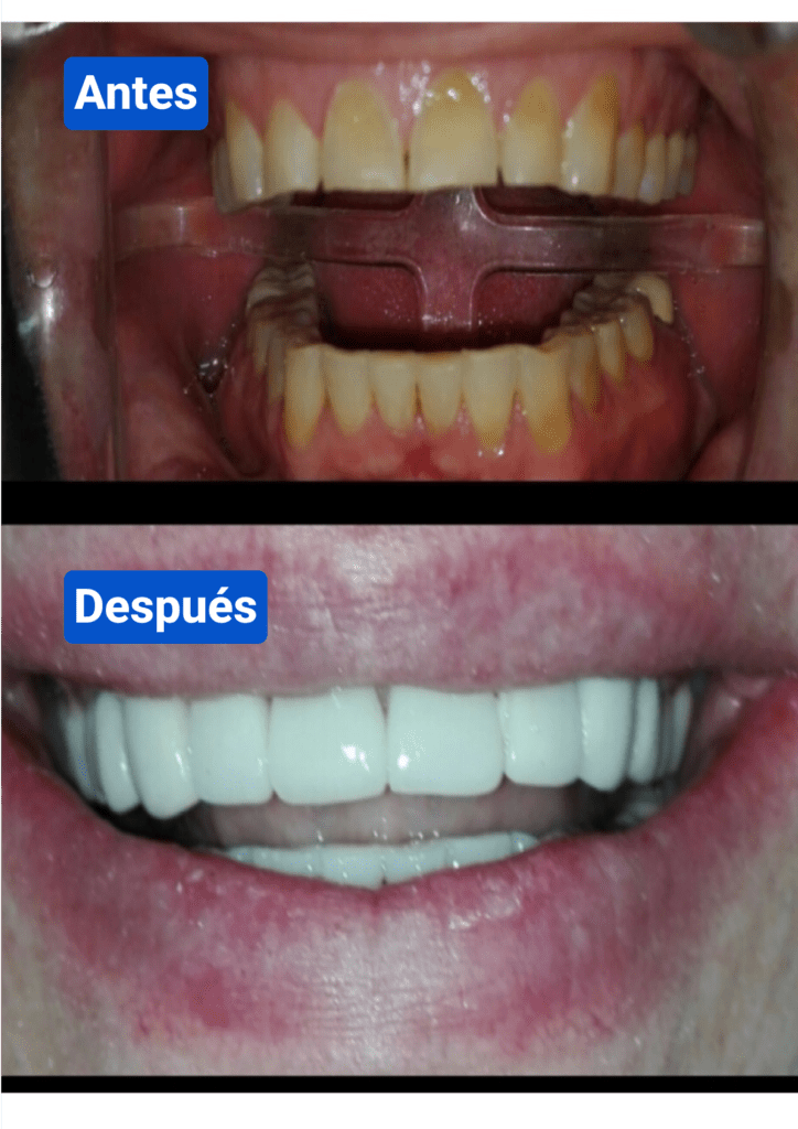 Before and after costa rica dental clinic