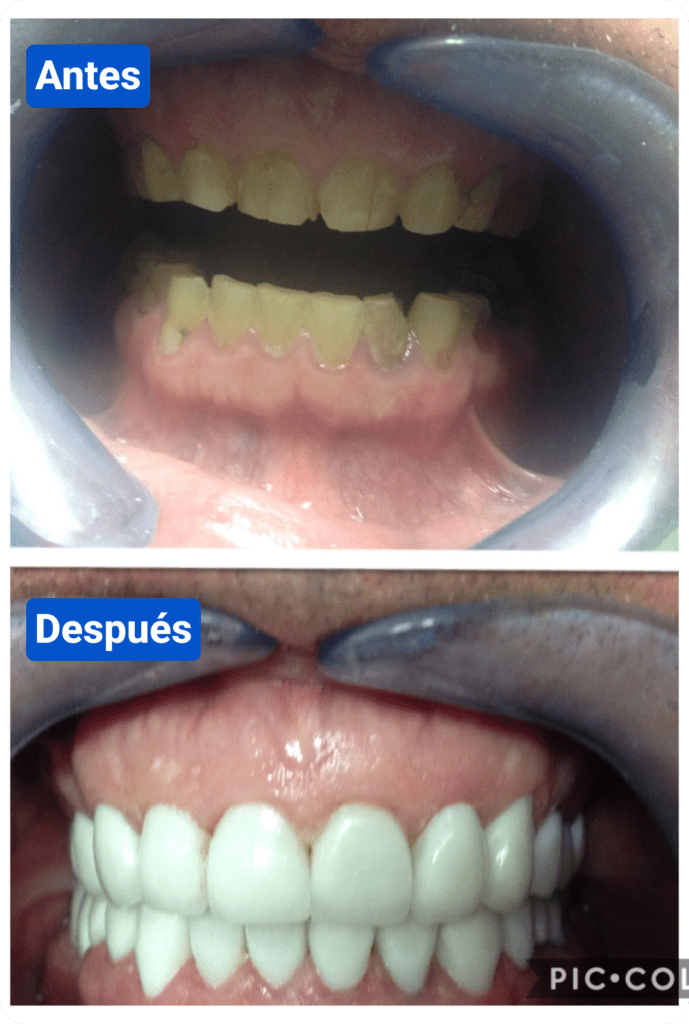 Before and after costa rica dental clinic