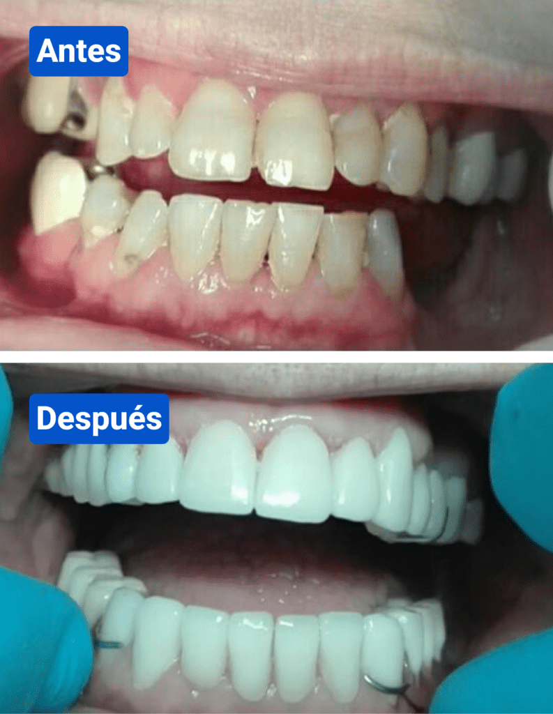 Before and after costa rica dental clinic