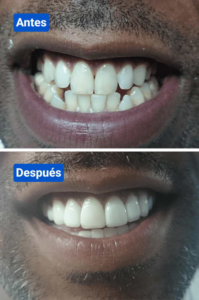 Before and after costa rica dental clinic