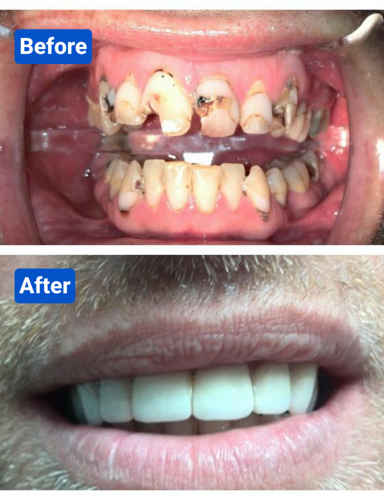 Before and after costa rica dental clinic