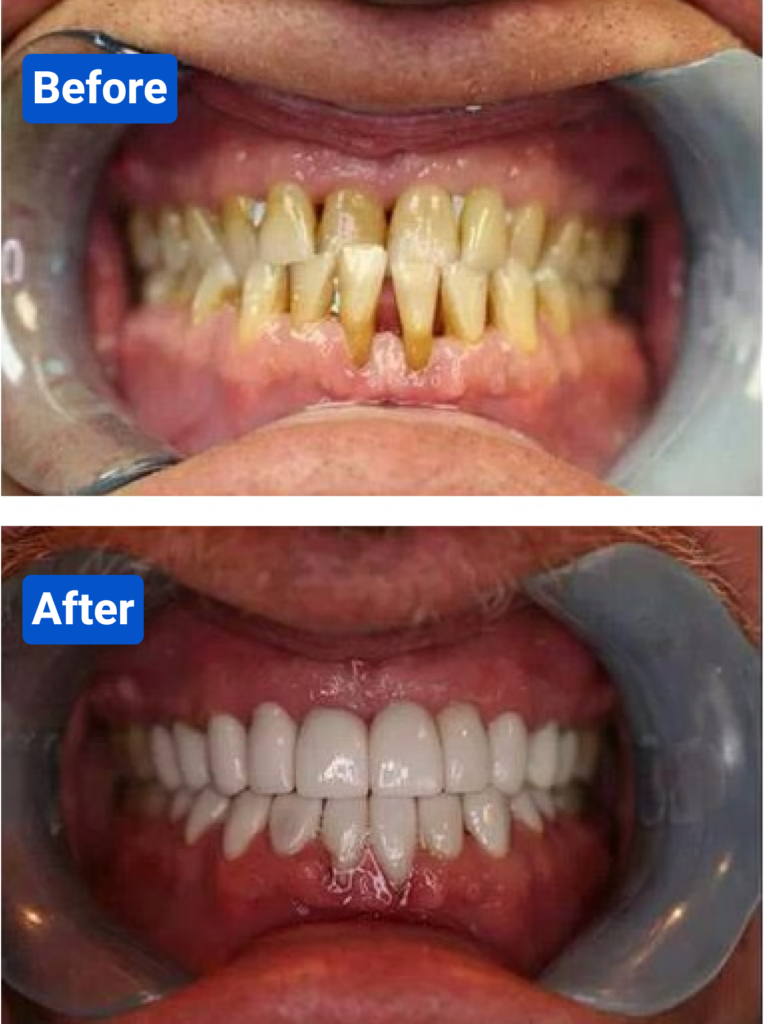 Before and after costa rica dental clinic