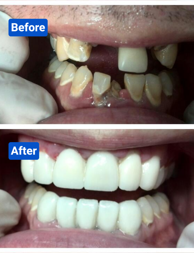 Before and after costa rica dental clinic