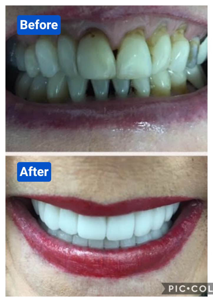 Before and after costa rica dental clinic