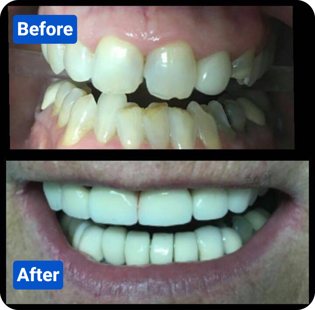 Before and after costa rica dental clinic