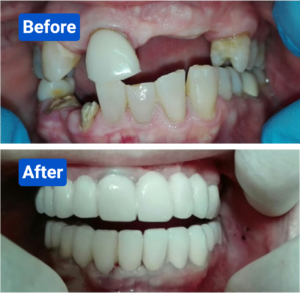 All on 6 Dental Implants in Costa Rica: What Every U.S. Patient Should Know Before and after costa rica dental clinic