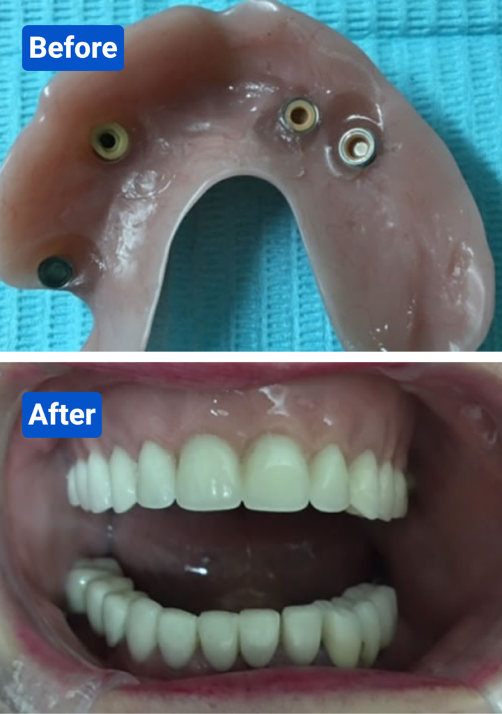 Before and after costa rica dental clinic