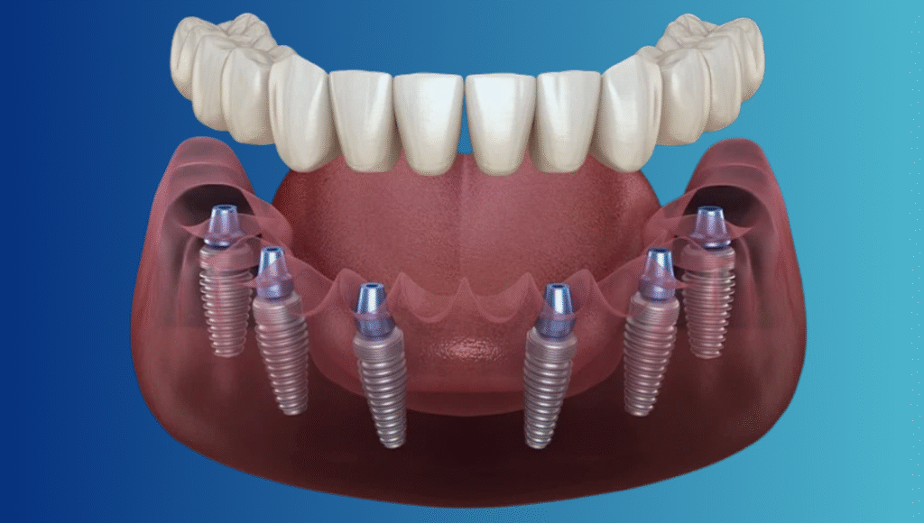 All on 6 Dental Implants in Costa Rica: What Every U.S. Patient Should Know