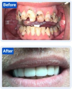 All on 6 Dental Implants in Costa Rica: What Every U.S. Patient Should Know after-before-hero