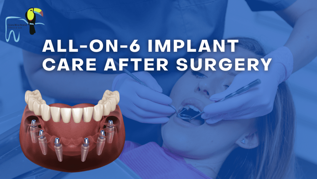 How to Take Care of Your All on 6 Dental Implants After Surgery How to Take Care of Your All on 6 Dental Implants After Surgery