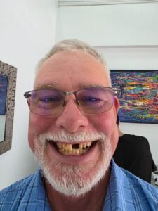 Jay’s Story: Costa Rica Dental Tourism Testimonial Before