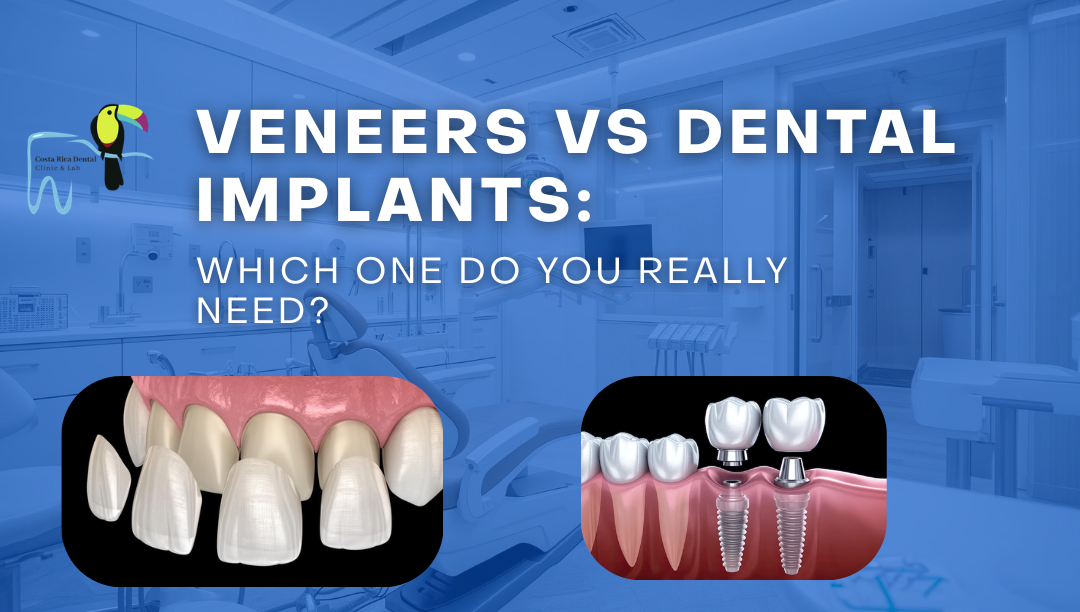 Veneers vs Dental Implants