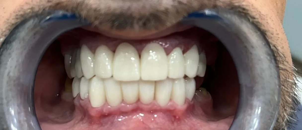 After restorative treatment