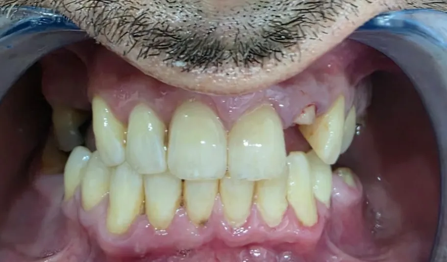 Before restorative treatment
