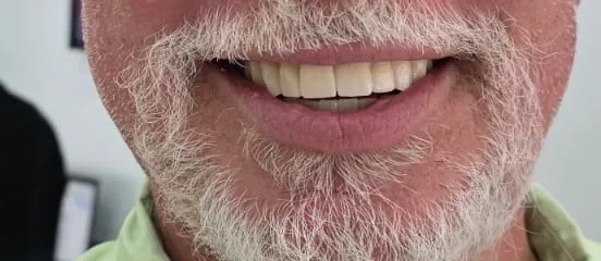 After full smile treatment