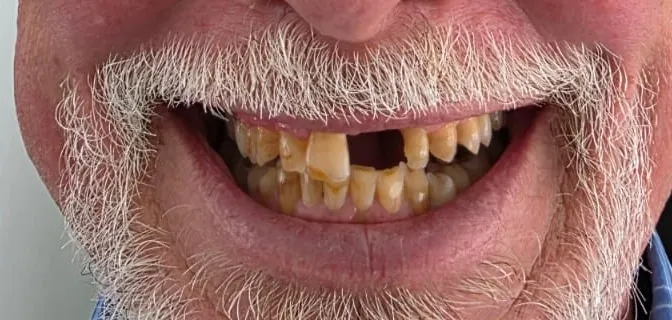 Before full smile treatment